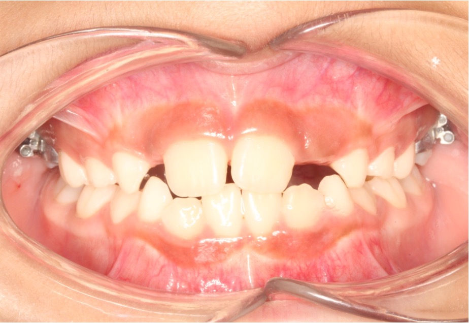 missing lateral incisors before