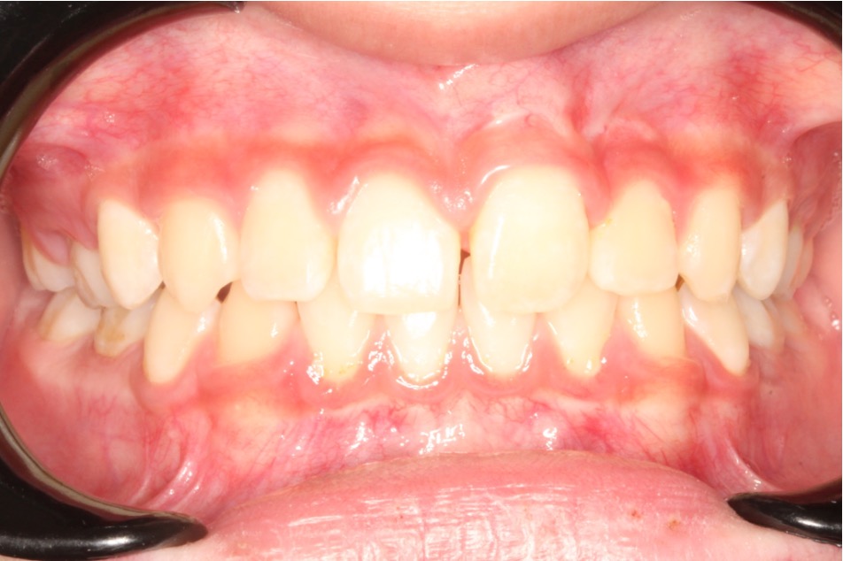 missing lateral incisors after